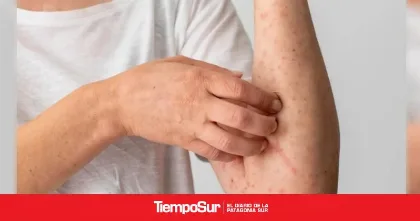 Alerta por brotes de sarampión en Argentina